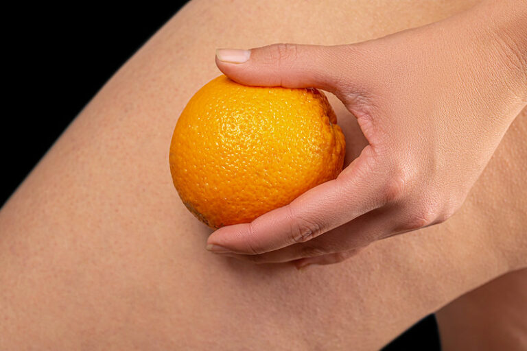 cellulite