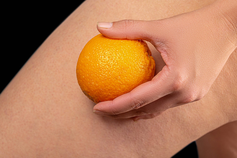 cellulite